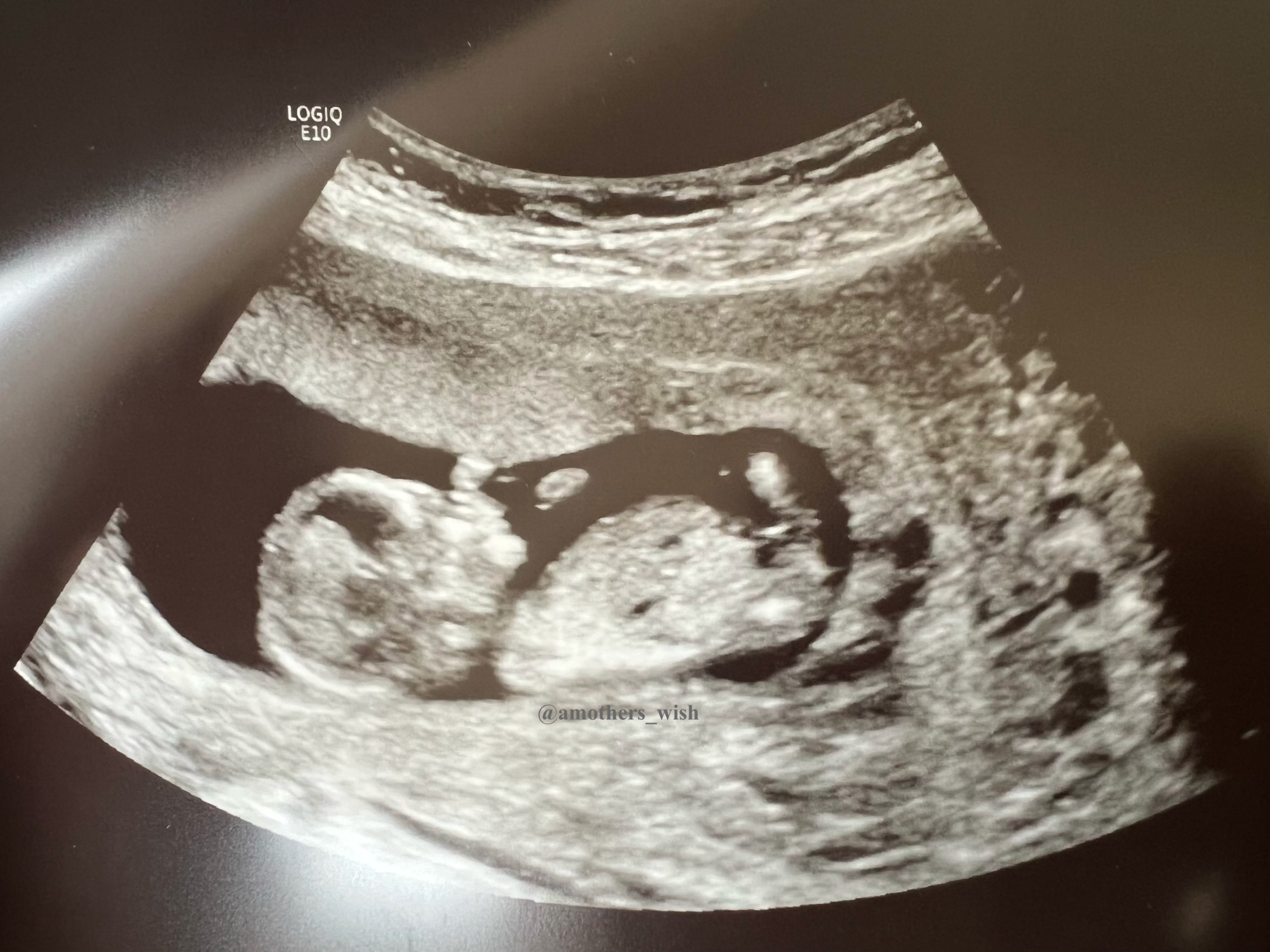 My Road to Motherhood